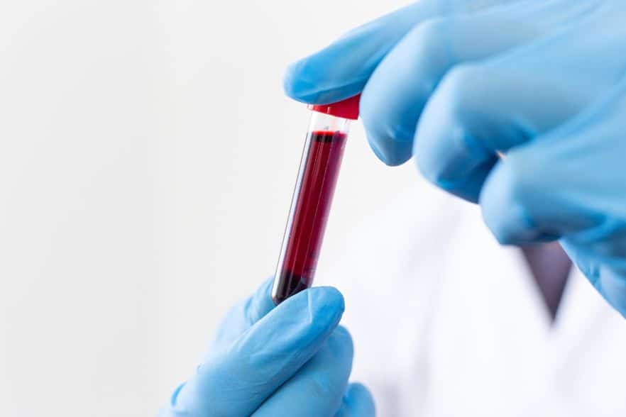 Neuer Bluttest erkennt Demenz 15 Jahre vor dem Ausbruch